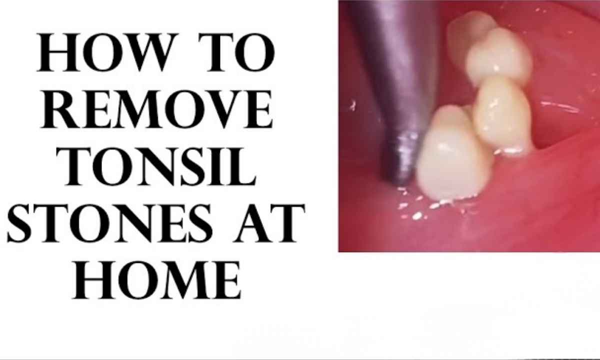 how to remove tonsil stones at home